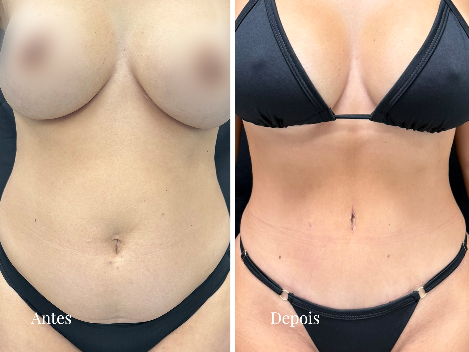 Imagem editorial relacionada a abdominoplastia